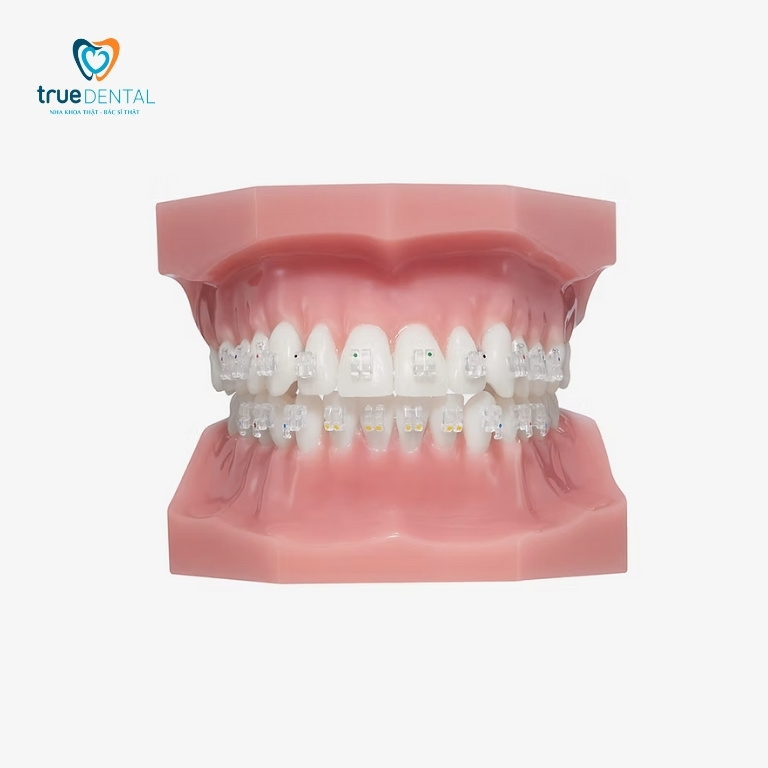 Niềng răng mắc cài được gắn vào răng như thế nào? 5 Mắc cài pha lê