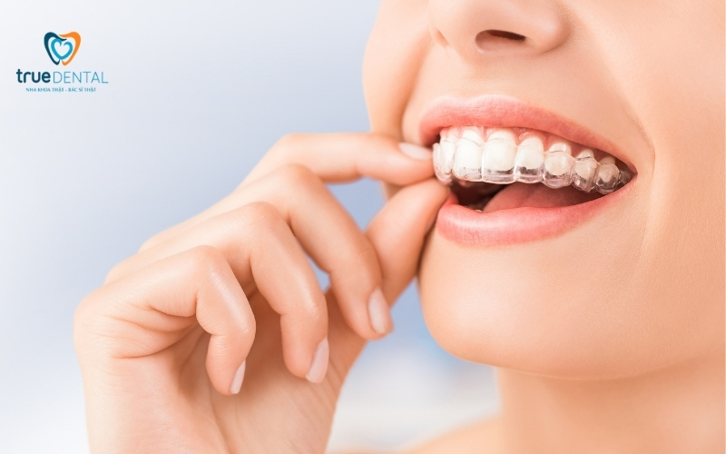 Niềng răng trong suốt được làm từ chất liệu gì