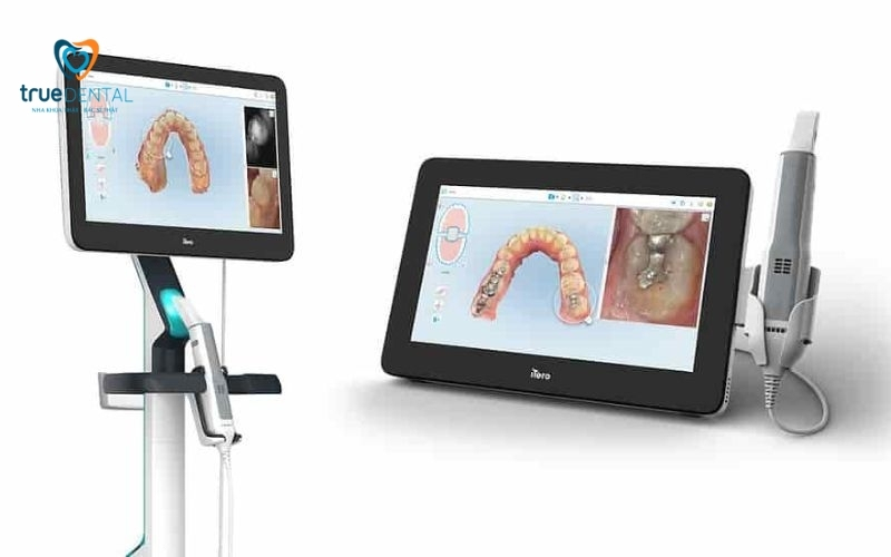 Niềng răng trong suốt được làm từ chất liệu gì