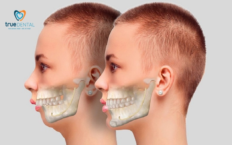 Răng bị hô có nên niềng răng sớm không? 1 Răng bị hô có nên niềng răng sớm không