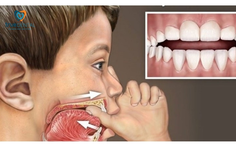 Răng bị hô có nên niềng răng sớm không? 2 Răng bị hô có nên niềng răng sớm không