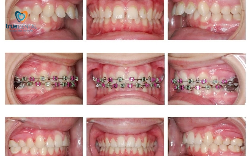 Răng bị hô có nên niềng răng sớm không? 4 Răng bị hô có nên niềng răng sớm không