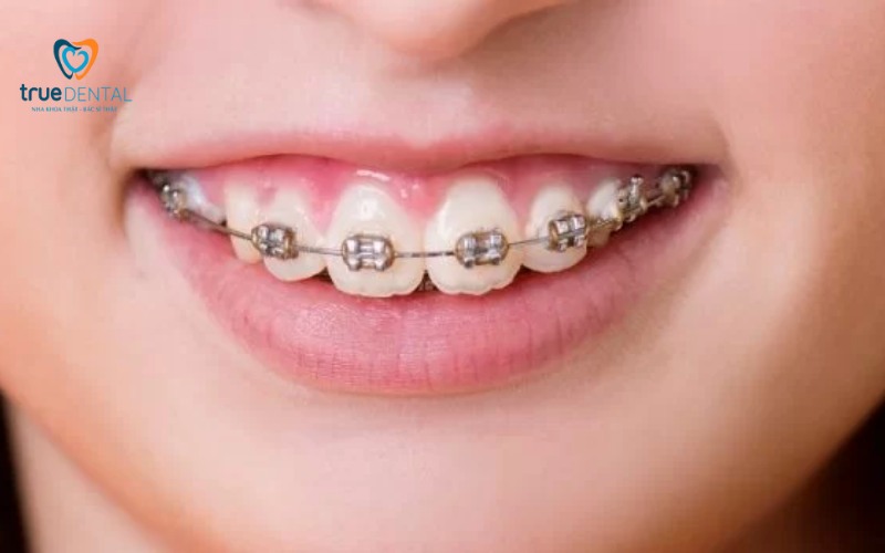Răng bị hô có nên niềng răng sớm không? 5 Răng bị hô có nên niềng răng sớm không
