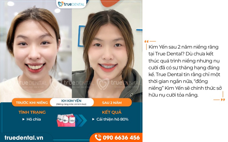 Răng bị hô có nên niềng răng sớm không? 7 Răng bị hô có nên niềng răng sớm không