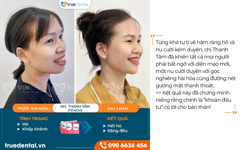 Răng bị hô có nên niềng răng sớm không? 6 Răng bị hô có nên niềng răng sớm không