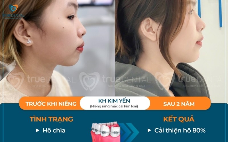 Răng hô nên niềng răng loại nào