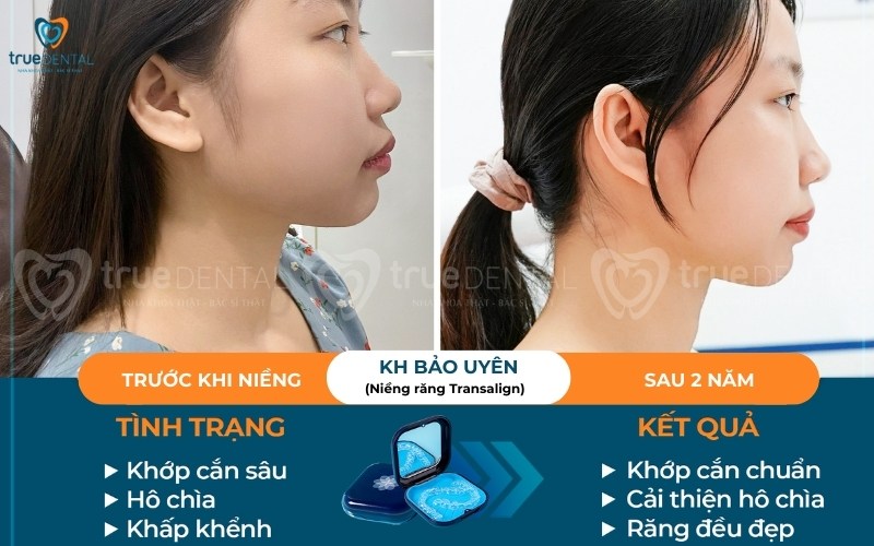 Răng hô nên niềng răng loại nào