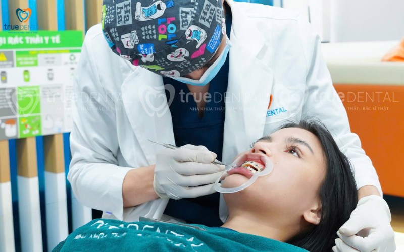 Răng hô nên niềng răng loại nào