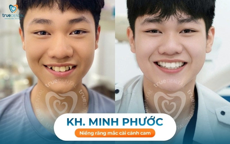 Răng hô nên niềng răng loại nào