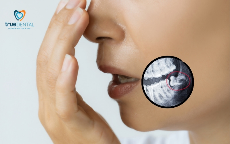Răng khôn mọc lệch có nên nhổ không