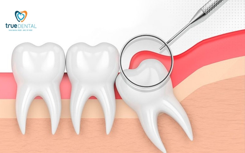 Răng khôn mọc lệch có nên nhổ không