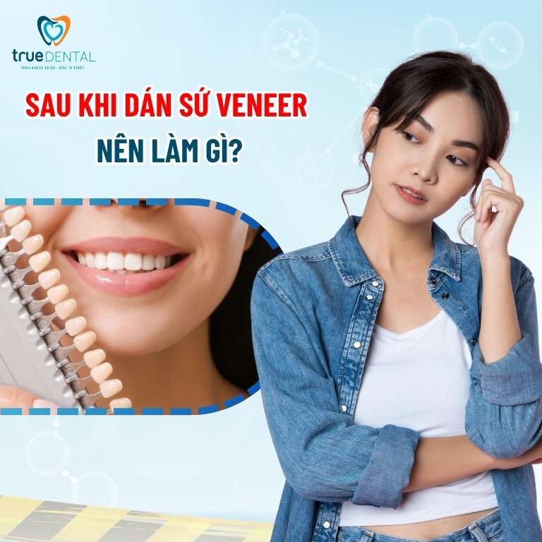 Sau khi dán sứ veneer nên làm gì? 1 Sau khi dán sứ Veneer nên làm gì?