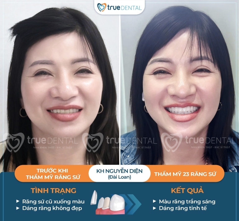 Sau khi dán sứ veneer nên làm gì? 4 Dán sứ veneer tại nha khoa True Dental
