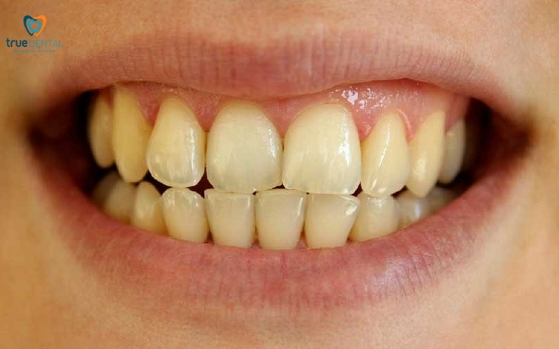 Răng sau khi tẩy trắng có bị vàng lại không? 2 Sau khi tẩy trắng răng có bị vàng lại không