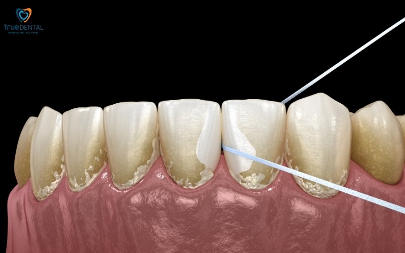 Tác dụng của chỉ nha khoa 2 tác dụng của chỉ nha khoa