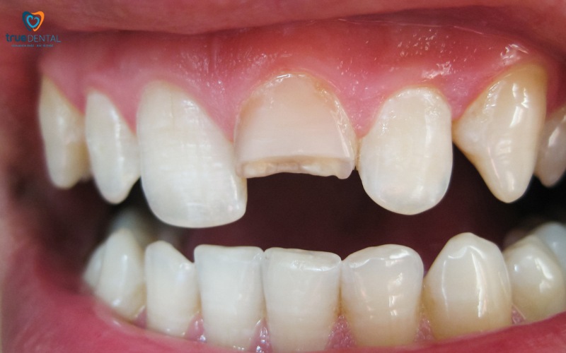 Các tác nhân xấu ảnh hưởng tới răng miệng và cách phòng ngừa 7 Tác nhân xấu ảnh hưởng tới răng miệng