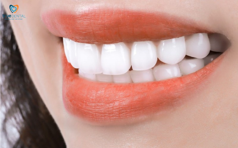 bọc răng sứ lava cho răng cửa