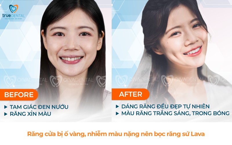 bọc răng sứ lava cho răng cửa