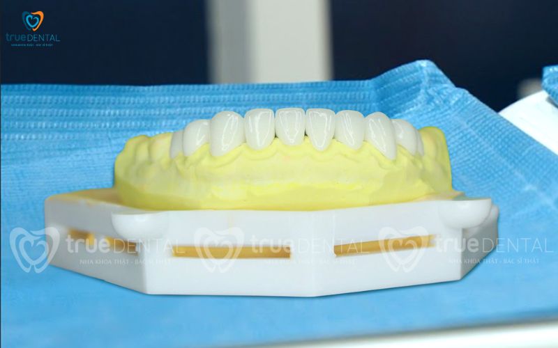 bọc răng sứ lava cho răng cửa