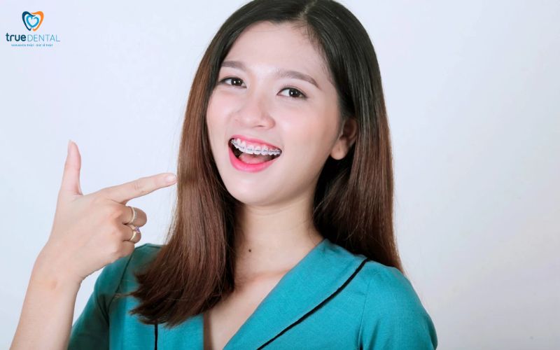 cách chọn mắc cài niềng răng cho người cao tuổi