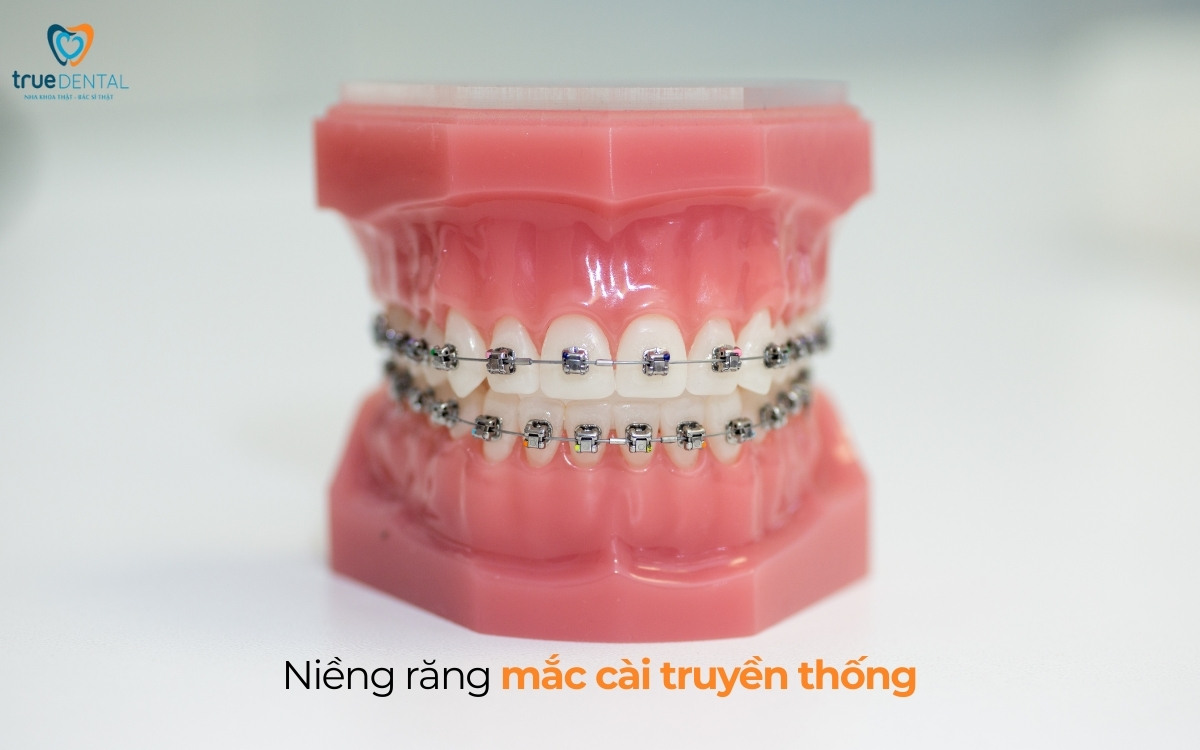 Cách chọn mắc cài niềng răng cho người lớn tuổi