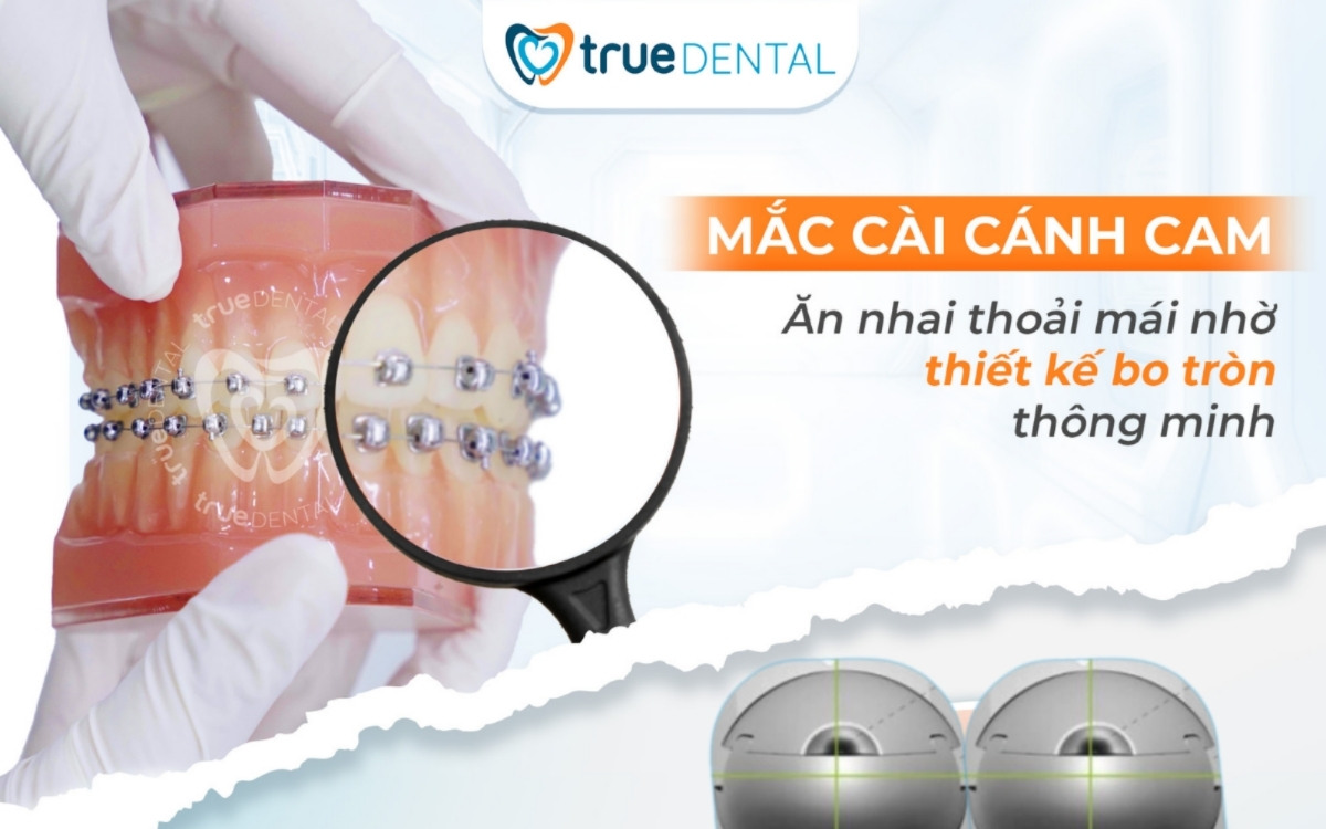 Cách chọn mắc cài niềng răng cho người lớn tuổi