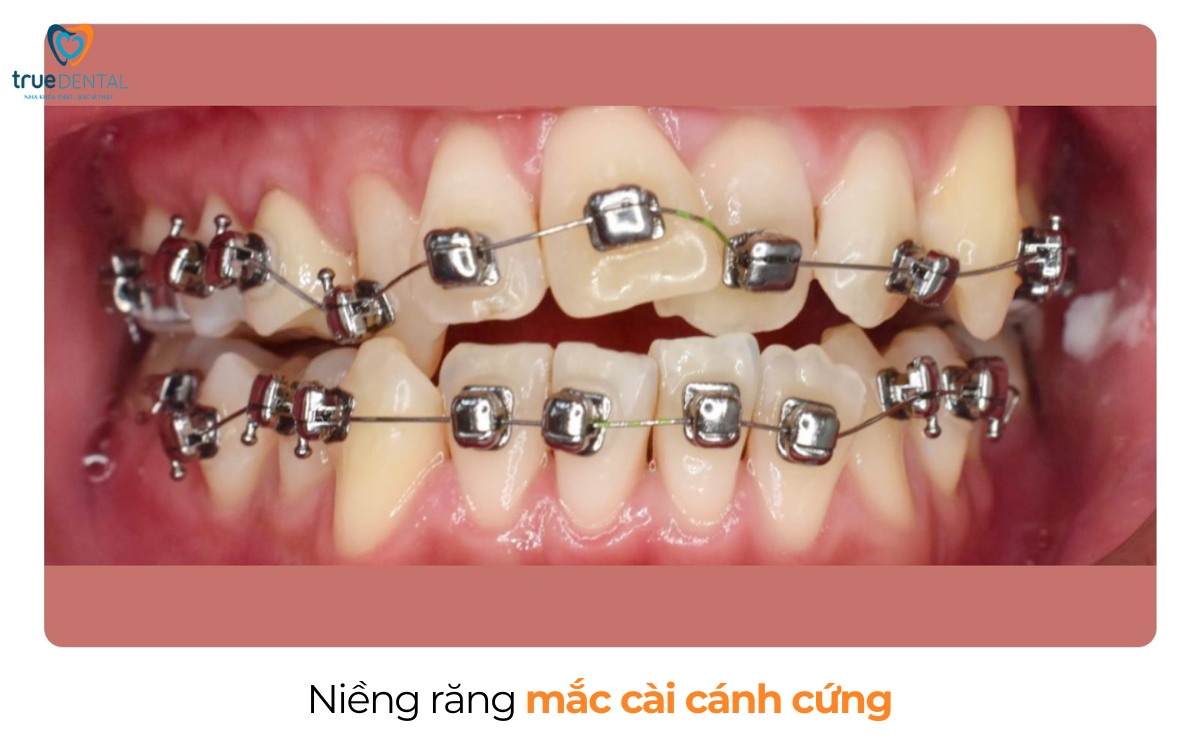 Cách chọn mắc cài niềng răng cho người lớn tuổi