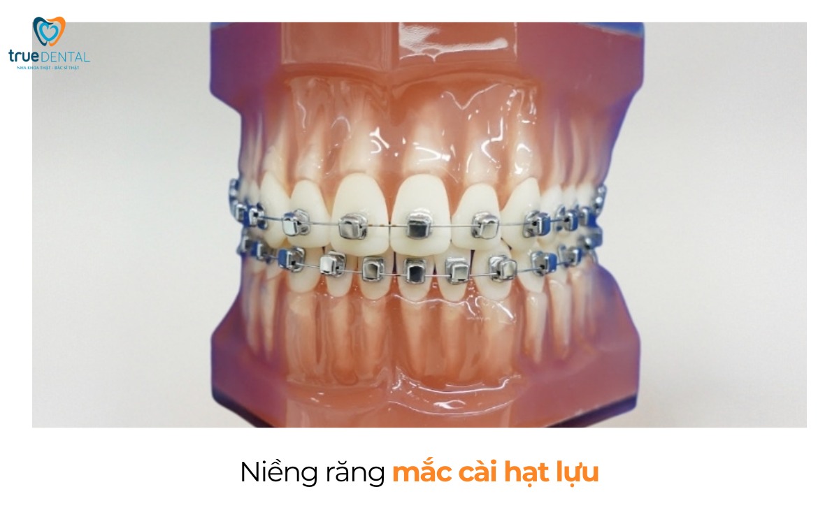 Cách chọn mắc cài niềng răng cho người lớn tuổi