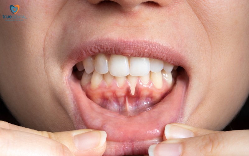 cách chọn răng sứ thích hợp cho người cao tuổi