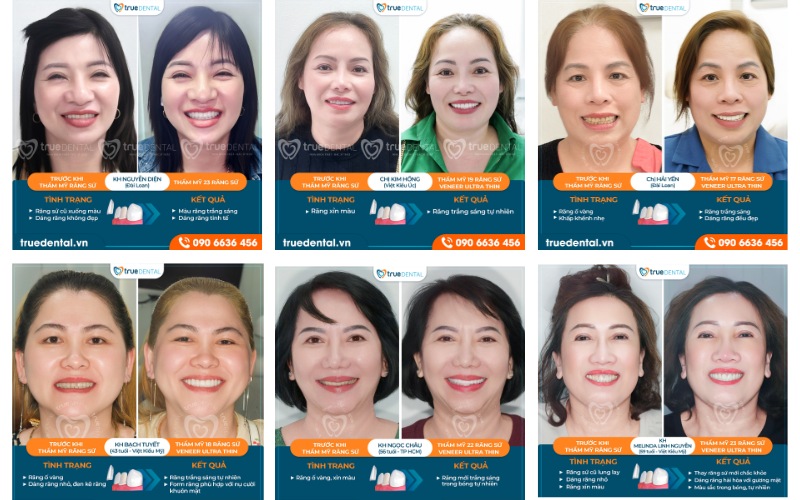 cách chọn răng sứ thích hợp cho người cao tuổi