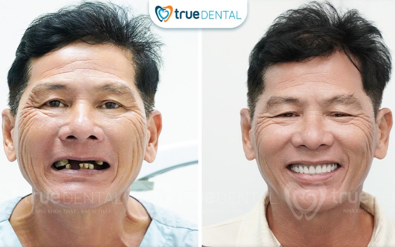 Cách chọn trụ Implant cho người cao tuổi hiệu quả 3 cách chọn trụ implant cho người cao tuổi