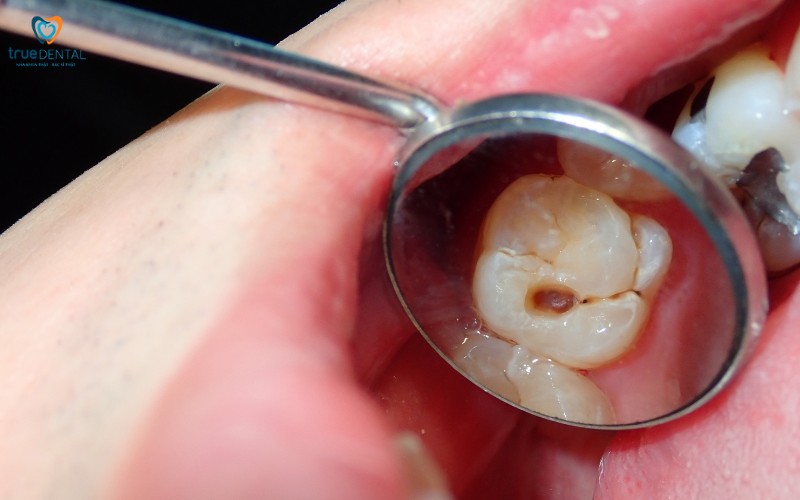 Cách phòng ngừa sâu răng cho trẻ em hiệu quả 2 Cách phòng ngừa sâu răng cho trẻ em
