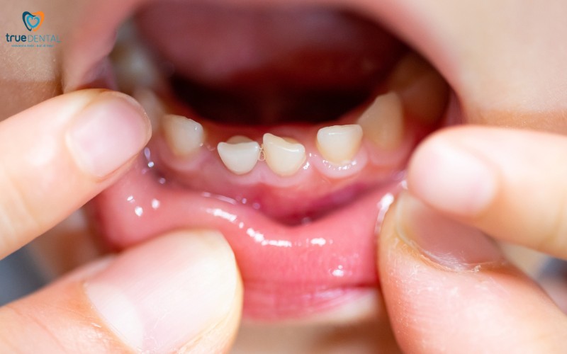 Cách phòng ngừa sâu răng cho trẻ em hiệu quả 6 Cách phòng ngừa sâu răng cho trẻ em