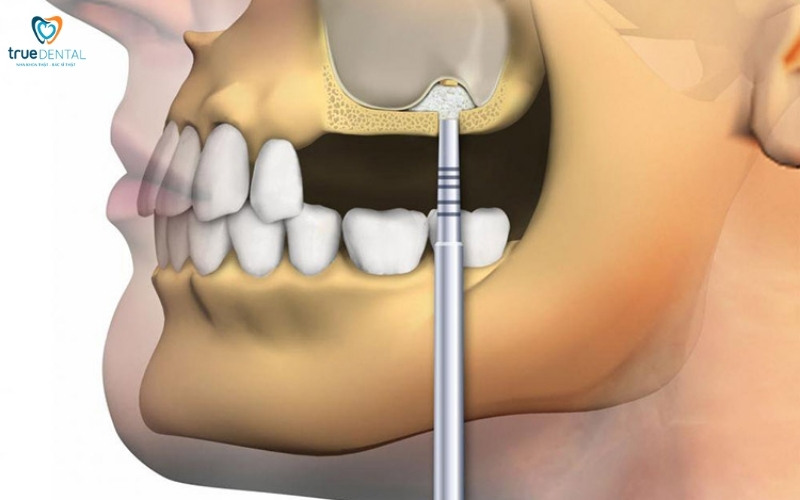 Cấy ghép implant có ảnh hưởng đến xoang hàm không? 3 cấy ghép implant có ảnh hưởng đến xoang hàm không?