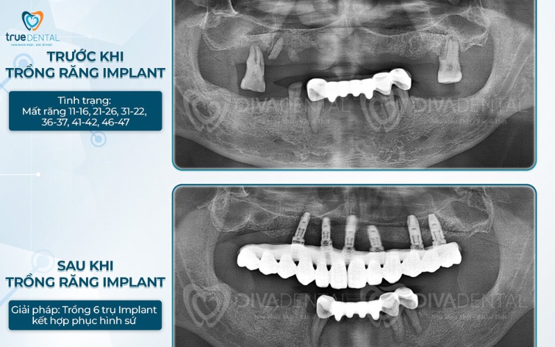 Cấy ghép implant có ảnh hưởng đến xoang hàm không? 7 cấy ghép implant có ảnh hưởng đến xoang hàm không?
