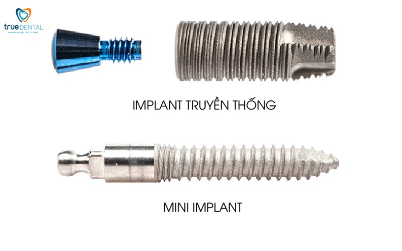 Cấy ghép implant mini cho răng cửa bị mất 1 Cấy ghép implant mini cho răng cửa bị mất