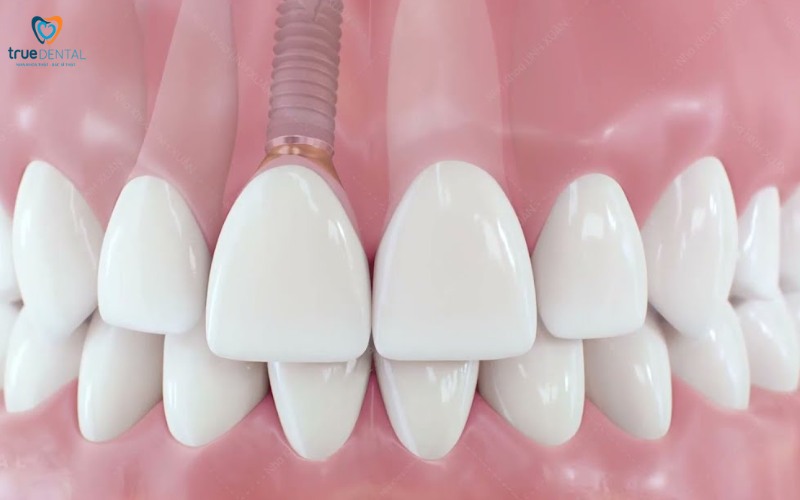 Cấy ghép implant mini cho răng cửa bị mất 2 Cấy ghép implant mini cho răng cửa bị mất