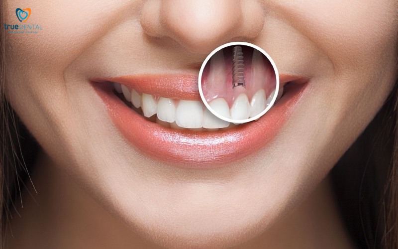 Cấy ghép implant mini cho răng cửa bị mất 4 Cấy ghép implant mini cho răng cửa bị mất