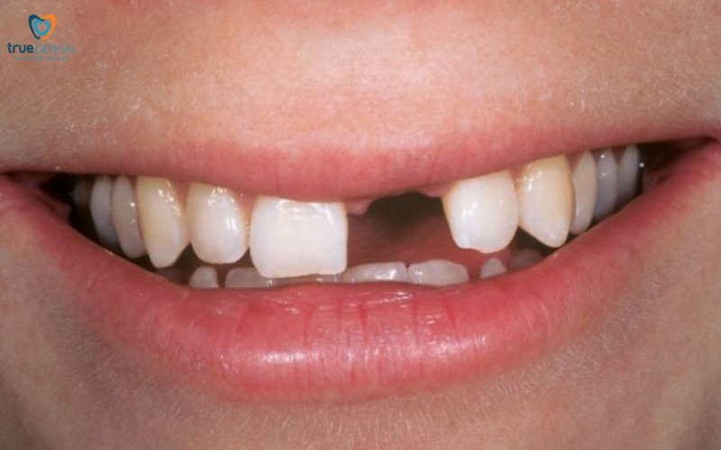 Cấy ghép implant mini cho răng cửa bị mất 5 Cấy ghép implant mini cho răng cửa bị mất
