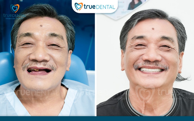 Chế độ ăn uống sau cấy ghép implant 1 tuần như thế nào? 6 Chế độ ăn uống sau cấy ghép implant 1 tuần