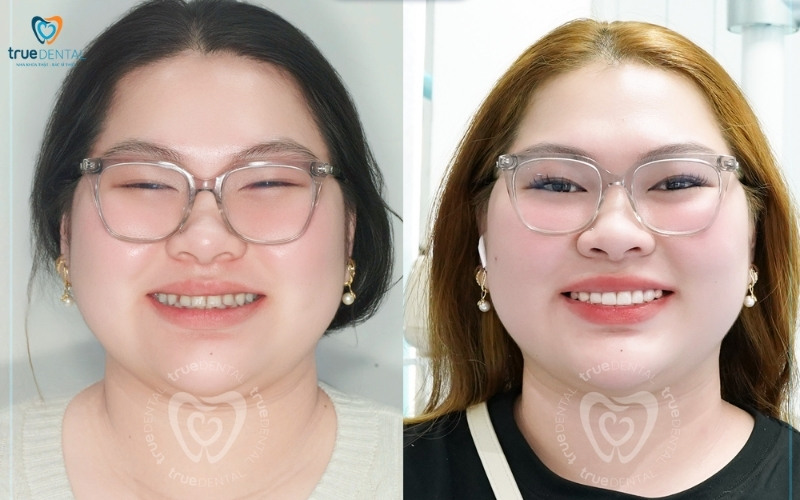 Chi phí bọc răng sứ Zirconia tại TP.HCM