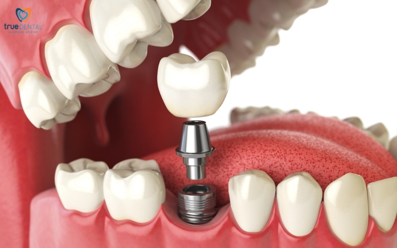 Chi phí cấy ghép implant một răng tại TP.HCM 2025 1 Chi phí cấy ghép implant một răng tại TP.HCM