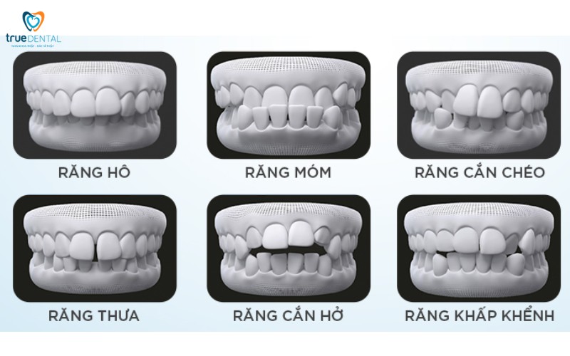 Chi phí niềng răng trong suốt tại tp.hcm