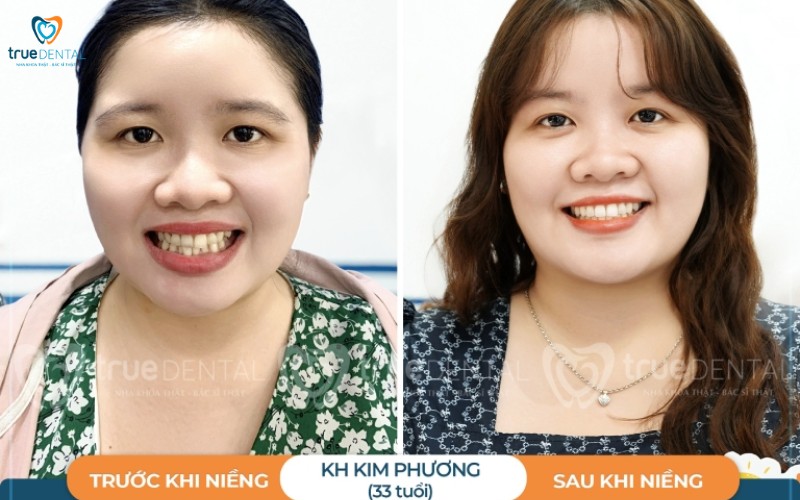 Chi phí niềng răng trong suốt tại tp.hcm