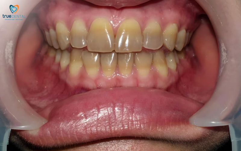 Chi phí tẩy trắng răng laser tại TP.HCM 2025 7 Cách phòng ngừa sâu răng cho trẻ em hiệu quả
