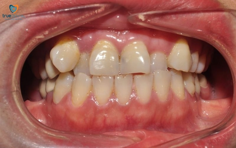 dán sứ veneer có ảnh hưởng tới răng không