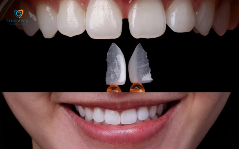 dán sứ veneer có ảnh hưởng tới răng không