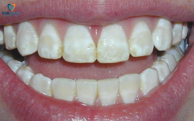 Đánh răng nhiều lần có làm ảnh hưởng răng không? 3 đánh răng nhiều lần có làm ảnh hưởng răng không