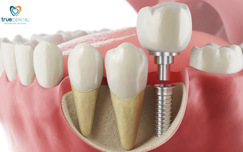 Địa chỉ cấy ghép implant giá rẻ tại TP.HCM 1 Địa chỉ cấy ghép implant giá rẻ tại TP.HCM