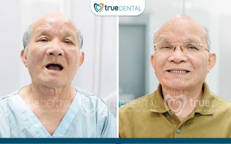Địa chỉ cấy ghép implant giá rẻ tại TP.HCM 5 Địa chỉ cấy ghép implant giá rẻ tại TP.HCM